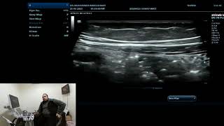 Introduction to BOWEL ultrasound [upl. by Eremaj]