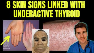 Doctor explains 8 SKIN SIGNS linked with HYPOTHYROIDISM aka underactive thyroid [upl. by Yenduhc]