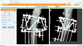 Correcting Leg Deformity Full Surgical Planning Explained with XRays [upl. by Aij]