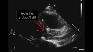 Destructed aortic valve [upl. by Sorel]