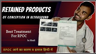 retained products of conception ultrasound in hindi  rpoc ultrasound in hindi  rpoc treatment [upl. by Alahc949]