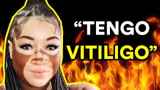 VIVIR CON VITILIGO Entrevista a Iomikoe Johnson [upl. by Mariellen481]