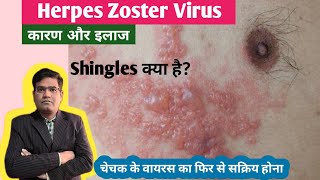 Herpes Zoster Shingles Disease Cause Symptoms and Treatment in Hindi  Varicella Zoster Virus [upl. by Alwin]