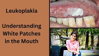 Leukoplakia Understanding White Patches in the Mouth [upl. by Edmunda]