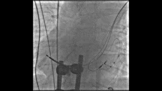 CRT implantation in a patient with dextrocardia situs solitus [upl. by Yhtac]