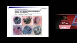 Diagnostica integrata del Melanoma nodulare Maria Antonietta Pizzichetta [upl. by Grosz]