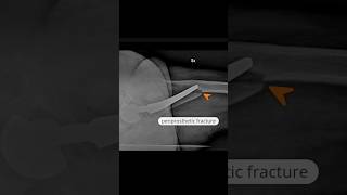 Periprosthetic femoral fracture  Vancouver type B2 xray [upl. by Anahir]