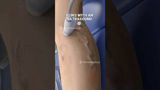 Super glue for your veins 3D Animation [upl. by Mathe]