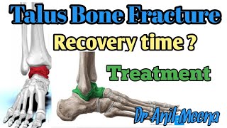 talus bone fracture recovery time  talus bone fracture treatment  talus fracture  in hindi [upl. by Lana]