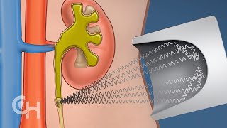 kidney stone laser operation 3D animated video  kidney stone operationKidney Stone treatment rirs [upl. by Dougy707]