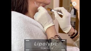 LIPOLYTIC INJECTIONS FOR FACIAL CONTOURING [upl. by Sankaran]