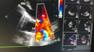 Sinus Venosus ASD SVC  Partial anomalous pulmonary Venosus connection [upl. by Legim]