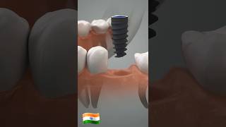 DENTAL IMPLANT 🦷dentist trending viralvideo dentalclinic [upl. by Yrailih]