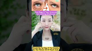 Eye Bags amp Tear Grooves Are Getting Shallower eyelift eyeexercise yoga faceyoga facialyoga fit [upl. by Fishback]