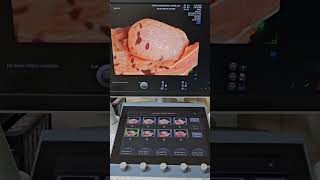 Testis Hydrocele 3D Ultrasound [upl. by Arok]