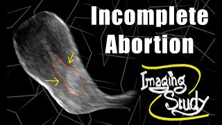 Incomplete Abortion  Retained Products of Conception  Ultrasound  Case 190 [upl. by Sommers139]