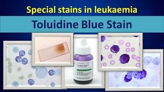 Toluidine blueSpecial stain in leukaemia [upl. by Ecenaj296]