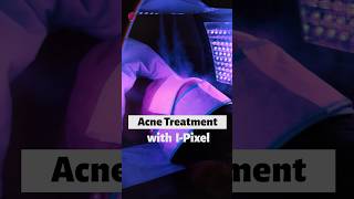 How to Improve Skin Texture  Laser Treatment for Acne  Best Dermatologist in Noida  Skinlogics [upl. by Norag]