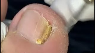 Onychomycosis Clean With knowledge sharing [upl. by Novikoff]