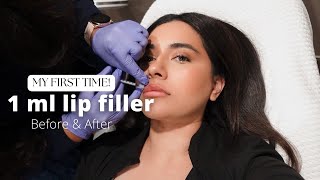 I GOT LIP FILLERS FOR THE FIRST TIME  1ML [upl. by Placida]