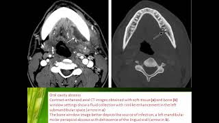 03 ERIC Head amp Neck Non Trauma  Emergency Imaging [upl. by Shirley]