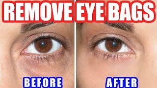 How to Get Rid of Bags Under Eyes – Best Way to Remove Under Eye Bags Naturally at Home [upl. by Annahsohs]