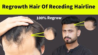 Its Truth  Regrowth Receding Hair line Hair Naturally  How To Regrowth Hair Line Naturally [upl. by Herrington226]