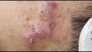 Hematoma Inflammation Acne HoangMySpa87 [upl. by Anastatius]