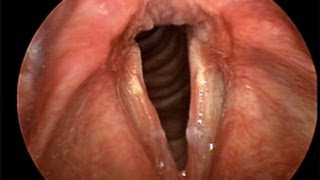 Laryngitis  a patient education video [upl. by Pare]