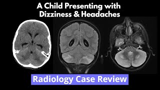 Radiology Case Review  A Child Presenting with Dizziness amp Headaches [upl. by Rojas]