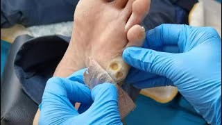 Pedicure Tutorial How to treat plantar wart Plantar wart removal Two warts on the sole [upl. by Llehcor]