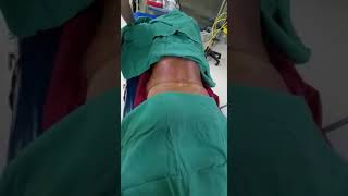 Vertebroplasty procedure  drNoman [upl. by Acinad]