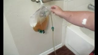 How Drain Urinary CATHETER BAG Release Pour Empty Remove Leg Urine Foley BARD Bardia Night Drainage [upl. by Pontus]