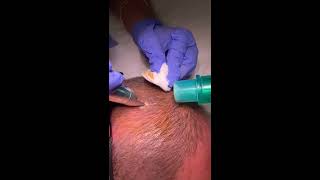 Seborrheic Keratosis treatment by Dr Nisha Jha [upl. by Gilmour858]