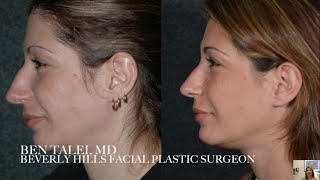 Beverly Hills  Minimally Invasive Closed Revision Rhinoplasty with Rapid Recovery [upl. by Guinevere]