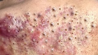 Loan Nguyen Acne Treatment 192 [upl. by Kensell671]