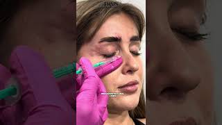 Full Face Botulinum Toxin Injection by Expert Doctor Prepare to Be Amazed [upl. by Busey]