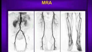 What is Peripheral Arterial Disease [upl. by Ragland]