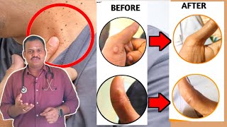 wart remover ointment review tamil  wart remover review in tamil  how to remove warts from skin [upl. by Trev]