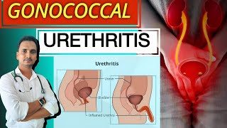 Gonococcal Urethritis treatment in Hindi  Homeopathic medicine for UTI  Neisseria Gonorrhoeae STD [upl. by Ardnua]