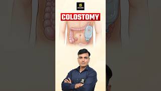 Colostomy Surgical Opening shorts utkarshnursing shailendrasir [upl. by Nehtanhoj]