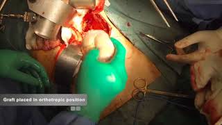 Orthotopic Kidney Transplantation [upl. by Nwhas]