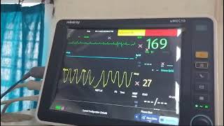 Tachypnoea in severe mitral stenosis with atrial fibrillation and fast ventricular rate [upl. by Cadell]