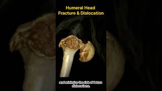 Humeral Head Fracture and Anterior Dislocation [upl. by Nairda]