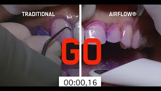 Abrasive teeth cleaning method vs AIRFLOW method [upl. by Subak797]