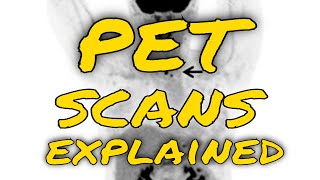 How do PET scans work to detect things such as cancer [upl. by Suitangi]