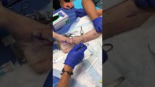 Posterior tibial tendon transfer Dr Edgardo RodriguezCollazo [upl. by Dominga]