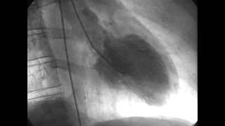 Procedural Coronary Angiography of Coronary Artery Thrombus Aspiration Followed by Bolus Intracorona [upl. by Ninaj556]