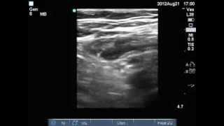 Ultrasound compression test for DVT Left Common Femoral Vein DVT present [upl. by Lehacim]