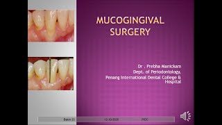 MUCOGINGIVAL SURGERY [upl. by Lynus804]